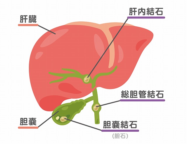 胆石・胆嚢炎とは？