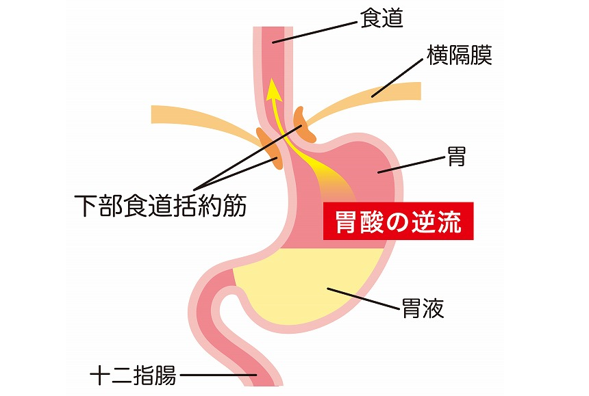 逆流性食道炎の主な原因と発症メカニズム