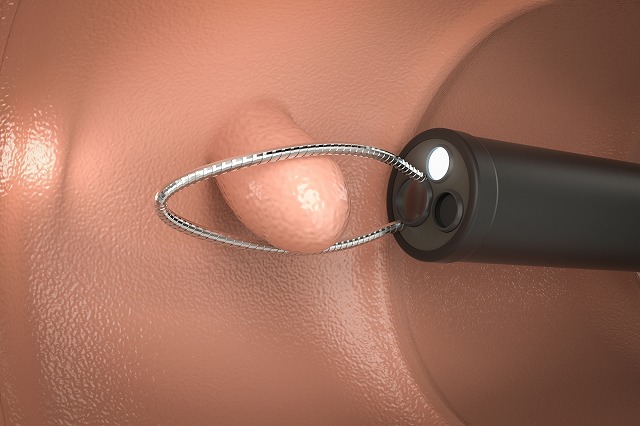 胃ポリープ：良性と悪性の違いを知る